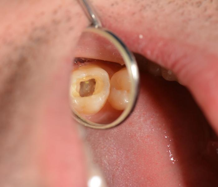 Endodoncija       Slika 7 od 7